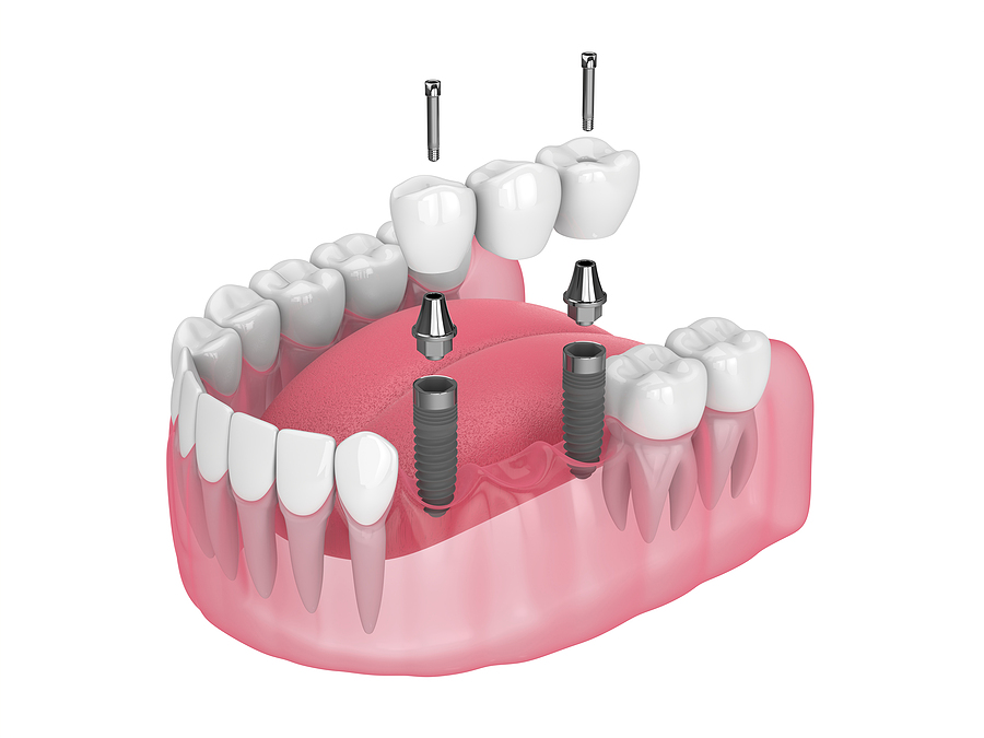 Dental Bridges: Bridging the Gap for a Complete Smile